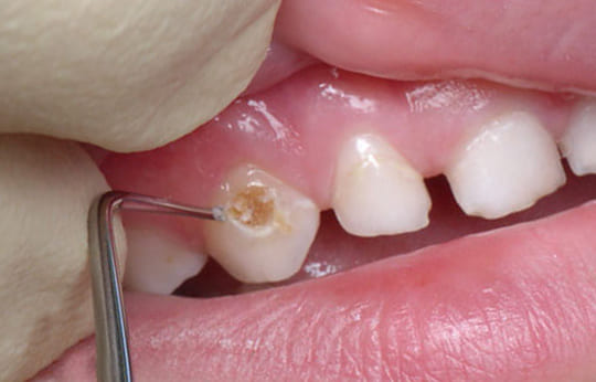 Лечение гипоплазии эмали зубов у детей
